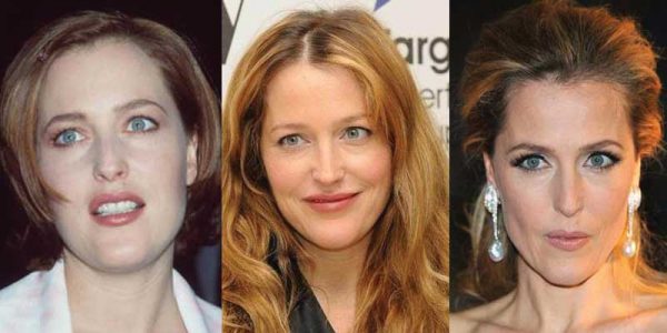 Gillian Anderson Plastic Surgery Before And After Pictures 2022